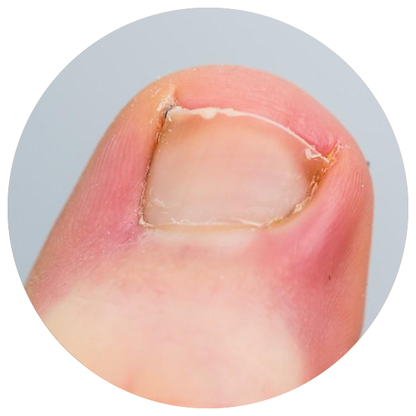 ingrown toenail